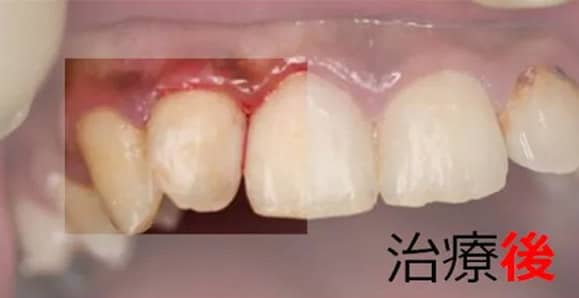 治療後