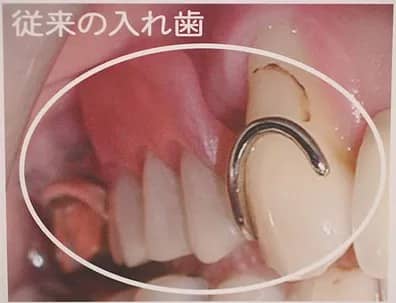 従来の入れ歯