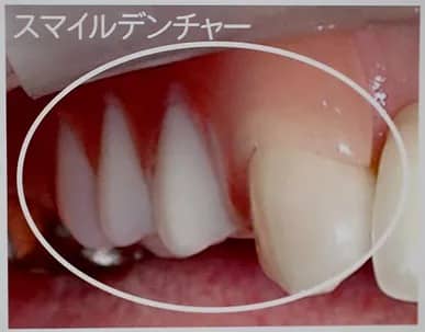 スマイルデンチャー