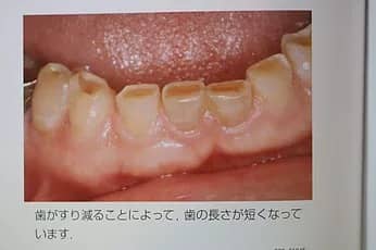 歯がすり減ることによって、歯の長さが短くなっています。