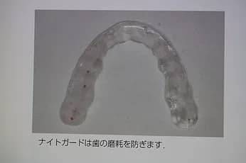 ナイトガードは歯の摩耗を防ぎます。