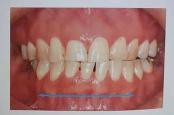 ​歯ぎしり顎関節症のマウスピース​